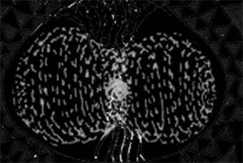 Spirit Coil, Overlapped phase